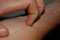 What Does a Food Allergy Rash Look Like? and How To Make It Go Away