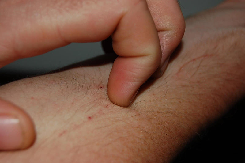 What Does a Food Allergy Rash Look Like? and How To Make It Go Away