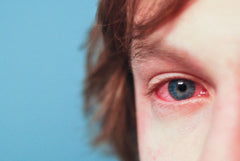 Best Eye Allergy Relief: Treating Itchy, Dry, Red Eyes